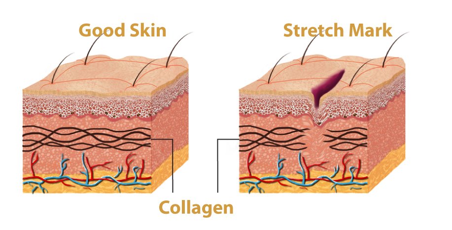 Collagen - Factors That Affect Scarring