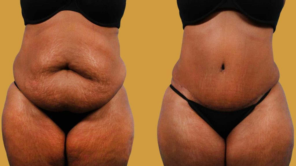 Lipo 360 Before and After Miami FL