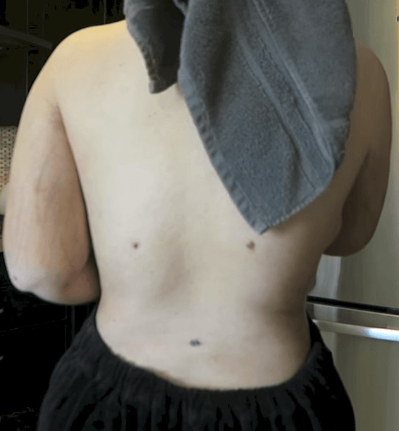 liposuction scar images