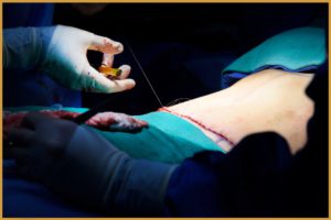 Pros and Cons of a Drainless Tummy Tuck
