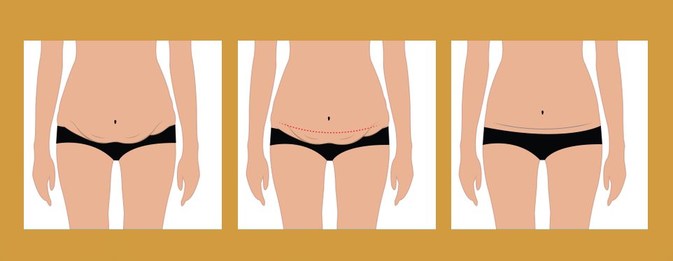 Results of Tummy Tuck on Skinny Person