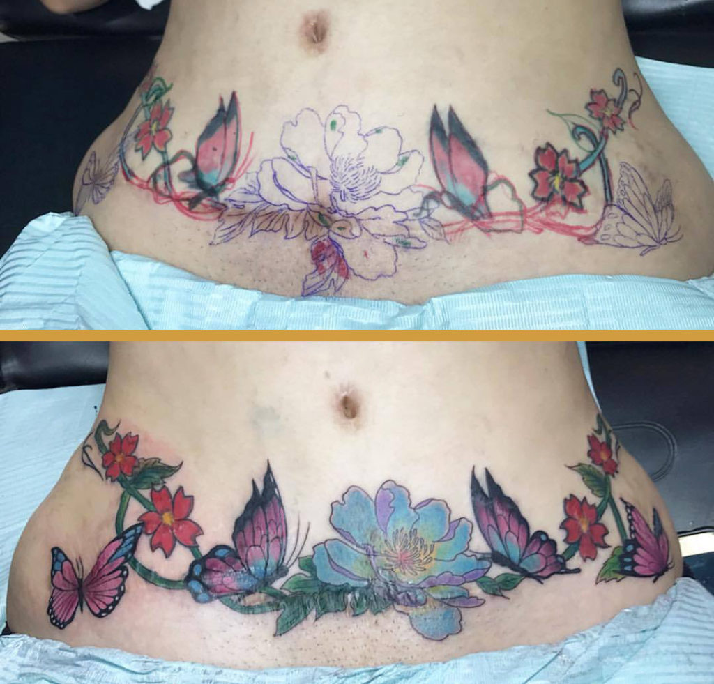 Mommy Makeover - Liposuction scar tattoo 2