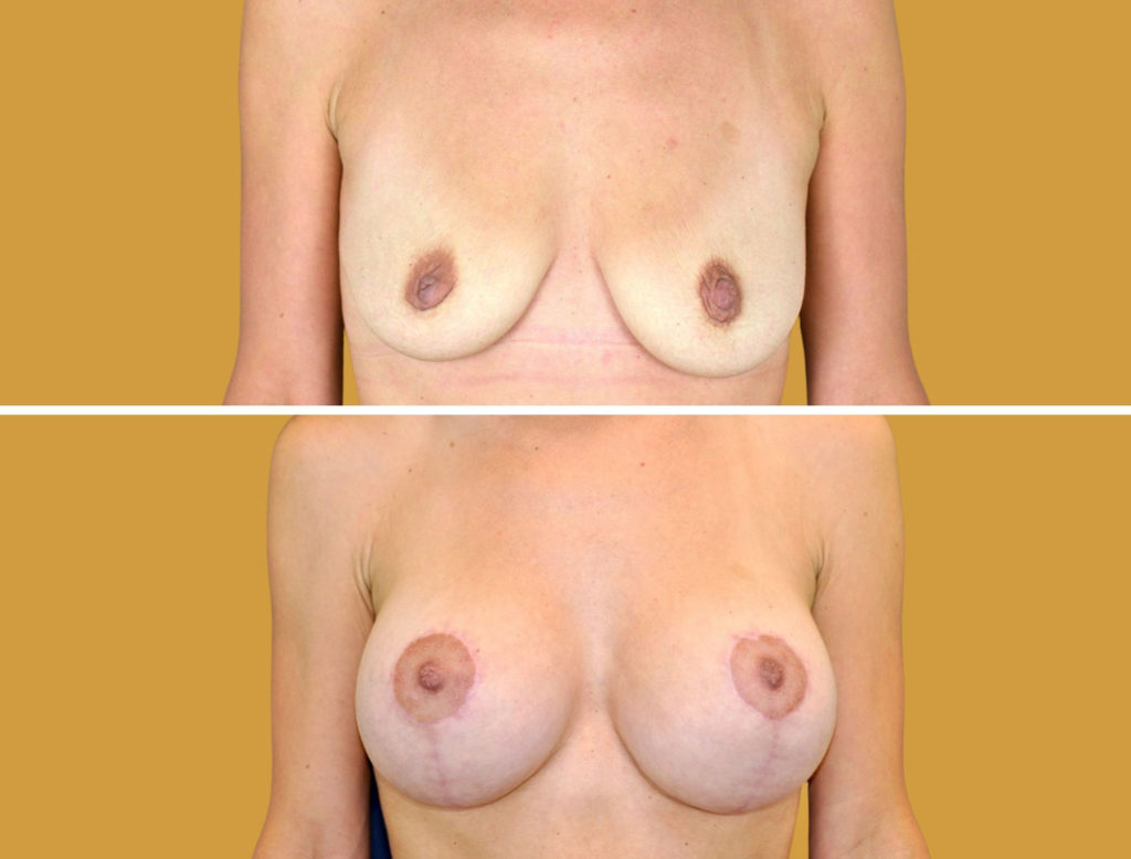 Breast Augmentation for Sagging Breasts Before and After