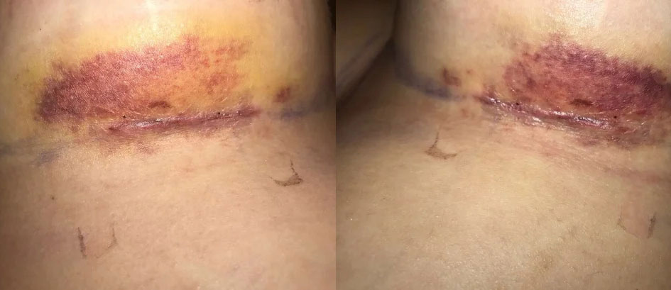 Bruising After Breast Augmentation 1